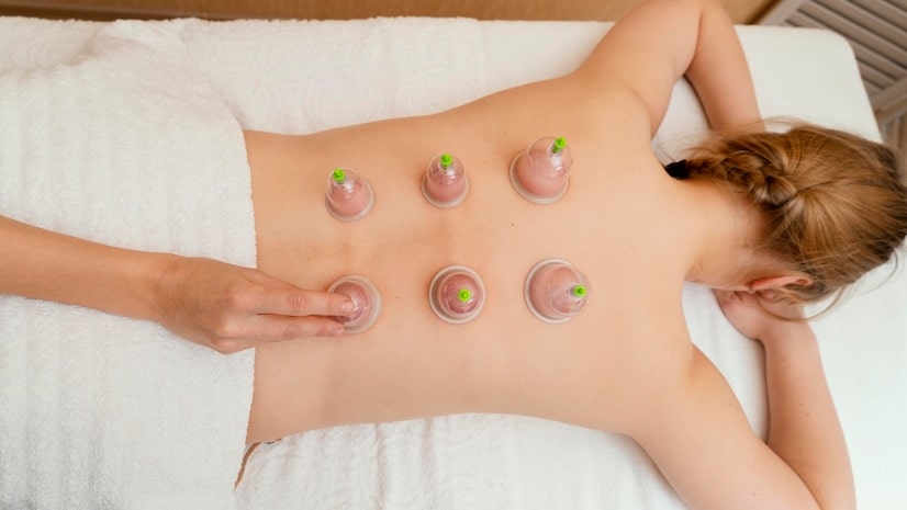 Traditional Cupping
